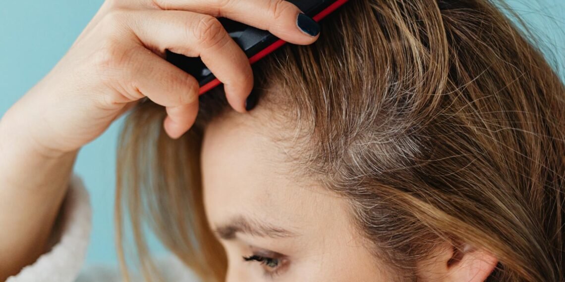 هل الأكسوزوم هو الحل للصلع الوراثى؟